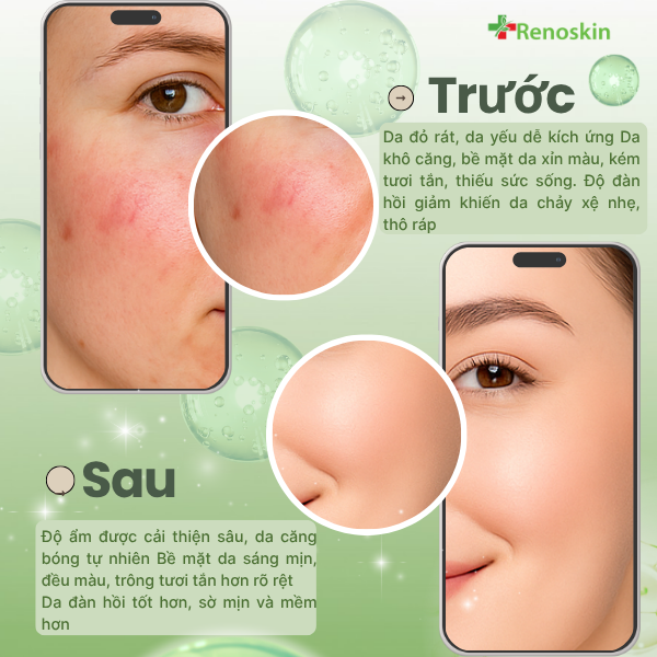 Kết cấu serum Renoskin HA Collagen mỏng nhẹ, thấm nhanh, cấp ẩm sâu cho da